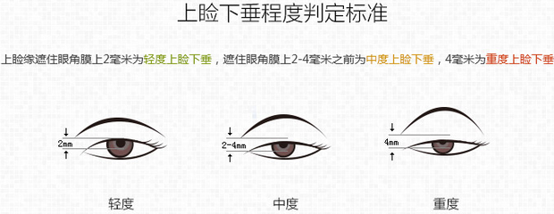 上瞼下垂程度