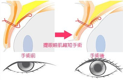 提上瞼肌縮短前后對(duì)比