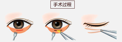 祛眼袋內路法